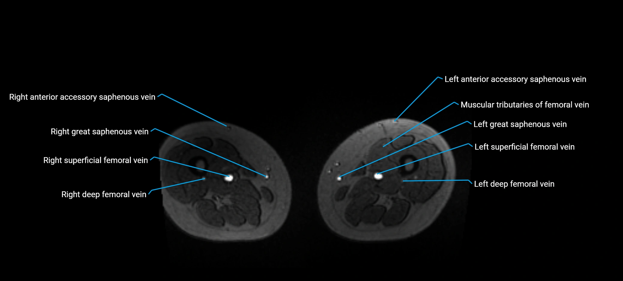 MRV abdomen pelvis & lower limb axial cross sectional anatomy labelled MRI image 290 (1).webp